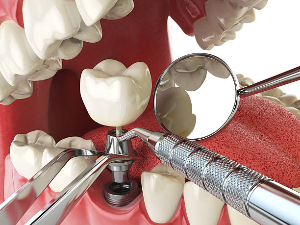 Best Emergency Tooth Extraction in Covedale, OH
