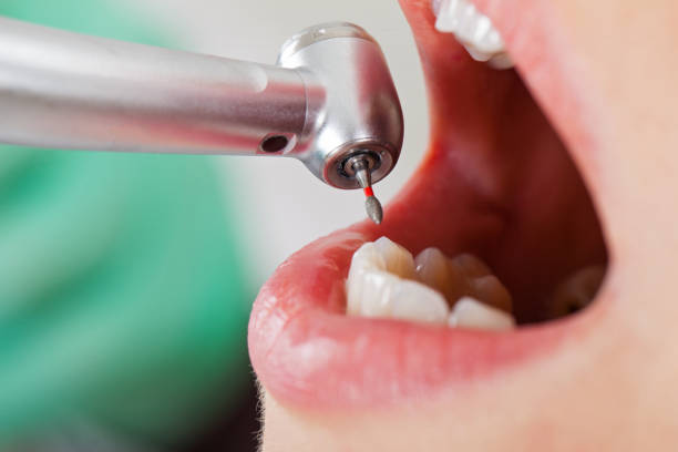 Best Emergency Tooth Extraction in Covedale, OH